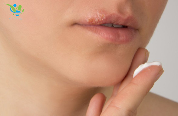 Cách xử lý mụn nước khi phun môi Cách xử lý mụn nước khi phun môi