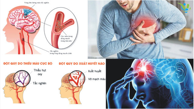 Đột quỵ là một trong những nguyên nhân gây tử vong hàng đầu Đột quỵ là một trong những nguyên nhân gây tử vong hàng đầu