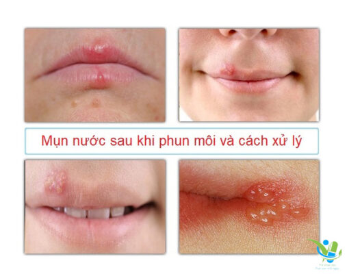 Mụn nước khi phun môi và cách xử lý Mụn nước khi phun môi và cách xử lý