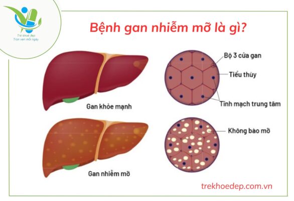 Bệnh gan nhiễm mỡ là gì?