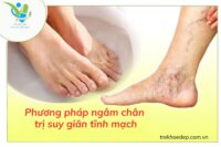 Phương pháp ngâm chân trị suy giãn tĩnh mạch
